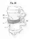 Fig. 12 - ANNULUS-REINFORCING BAND