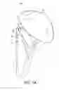 Fig. 02 - Fenestrated humeral prosthesis and methods of shoulder arthroplasty
