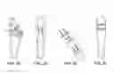 Fig. 05 - Fenestrated humeral prosthesis and methods of shoulder arthroplasty