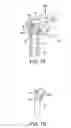 Fig. 16 - Fenestrated humeral prosthesis and methods of shoulder arthroplasty