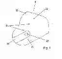 Fig. 06 - Prosthesis socket