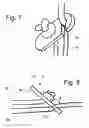Fig. 06 - Stabilizing apparatus for inclined legs
