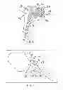 Fig. 02 - Method for optimization of joint arthroplasty component design