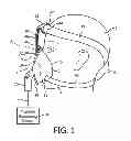 Fig. 02 - Patient interface device with nose bridge adjustment
