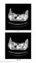 Fig. 07 - Computed tomography system with dynamic bowtie filter