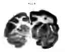 Fig. 16 - Methods and compositions for increasing arylsulfatase A activity in the CNS