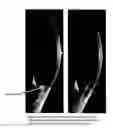 Fig. 01 - Microsphere drug delivery system for sustained intraocular release
