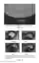 Fig. 04 - Microsphere drug delivery system for sustained intraocular release