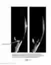 Fig. 06 - Microsphere drug delivery system for sustained intraocular release