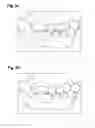 Fig. 07 - TOOTH REPLACEMENT