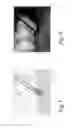 Fig. 09 - Bio-resorbable debride or implant cleaning tool and method of manufacturing the same