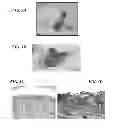 Fig. 04 - METHOD OF PREVENTING DEVELOPMENT OF PSORIATIC LESIONS