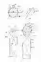 Fig. 07 - Implantable device utilizing arterial deformation
