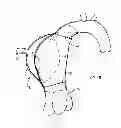 Fig. 08 - Implantable device utilizing arterial deformation