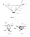 Fig. 04 - Ventricular volume reduction