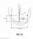 Fig. 28 - Ventricular volume reduction