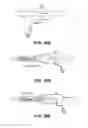 Fig. 34 - Ventricular volume reduction
