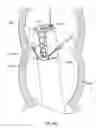 Fig. 135 - Image capture assembly for use in a multi-viewing elements endoscope