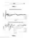Fig. 02 - Method and apparatus for measurement of neural response