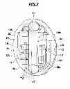 Fig. 03 - IMPLANTABLE PRESSURE MEASURING DEVICE