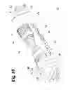 Fig. 15 - Analgesic implant device and system