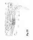 Fig. 26 - Analgesic implant device and system