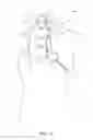 Fig. 02 - Methods and Systems for Establishing Retrograde Carotid Arterial Blood Flow