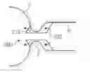 Fig. 01 - TRANSPYLORIC ANCHORING