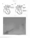 Fig. 02 - Occlusion device for closing anatomical defects