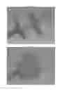 Fig. 04 - Occlusion device for closing anatomical defects