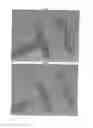 Fig. 06 - Occlusion device for closing anatomical defects