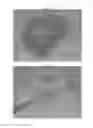 Fig. 08 - Occlusion device for closing anatomical defects