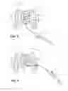 Fig. 05 - Multipolarity epicardial radiofrequency ablation