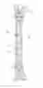 Fig. 01 - Osteosynthesis system for the multidirectional, angular-stable treatment of fractures of tubular bones comprising an intramedullary nail and bone screws