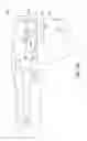 Fig. 25 - Cut guide attachment for use in tibial prosthesis systems