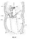 Fig. 136 - Multiple Viewing Elements Endoscope Having Two Front Service Channels