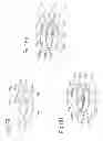 Fig. 50 - DEVICE FOR REMOVING ACROCHORDONS