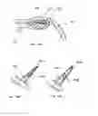 Fig. 15 - Devices and methods for percutaneous tissue removal