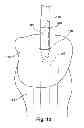Fig. 11 - Devices and methods for tissue graft delivery