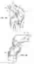 Fig. 02 - Attachment device to attach tissue graft
