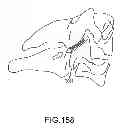 Fig. 131 - VERTEBRAL JOINT IMPLANTS AND DELIVERY TOOLS