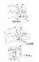 Fig. 40 - VERTEBRAL JOINT IMPLANTS AND DELIVERY TOOLS
