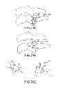 Fig. 70 - VERTEBRAL JOINT IMPLANTS AND DELIVERY TOOLS