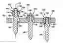 Fig. 01 - Orthopedic anchor assembly