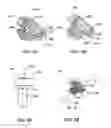 Fig. 06 - Orthopedic anchor assembly