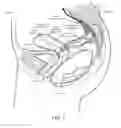 Fig. 02 - Devices and methods for stimulating nerves