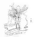 Fig. 02 - PULSED INFRARED MODULATION OF A PHOTOVOLTAIC CELL COCHLEAR IMPLANT FOR THE MULTICHANNEL ELECTRICAL DEPOLARIZATION OF SPIRAL GANGLION CELLS TO ACHIEVE SOUND PERCEPT