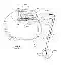 Fig. 03 - Electromagnetic shield for a passive electronic component in an active medical device implantable lead
