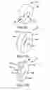 Fig. 16 - Bipolar active cardiac electrical lead