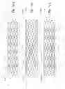 Fig. 06 - Gradually self-expanding stent